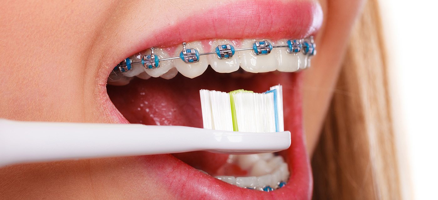cepillado-de-dientes-con-ortodoncia