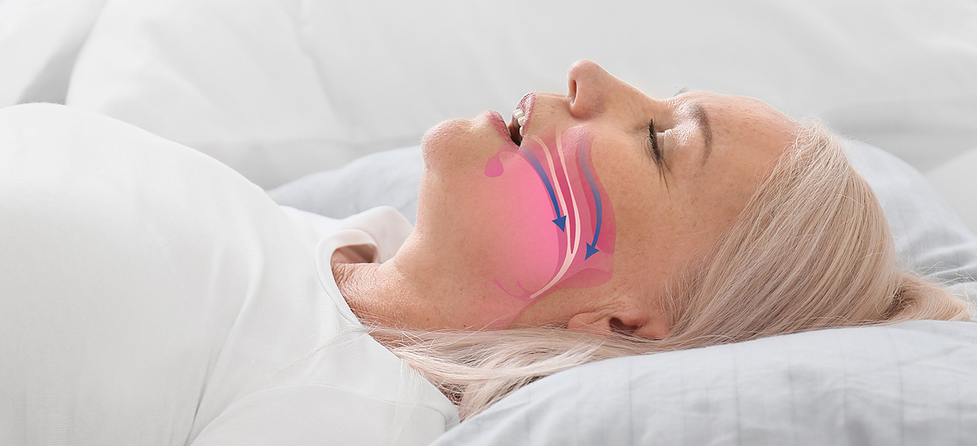 Mujer durmiendo con apnea obstructiva del sueño 