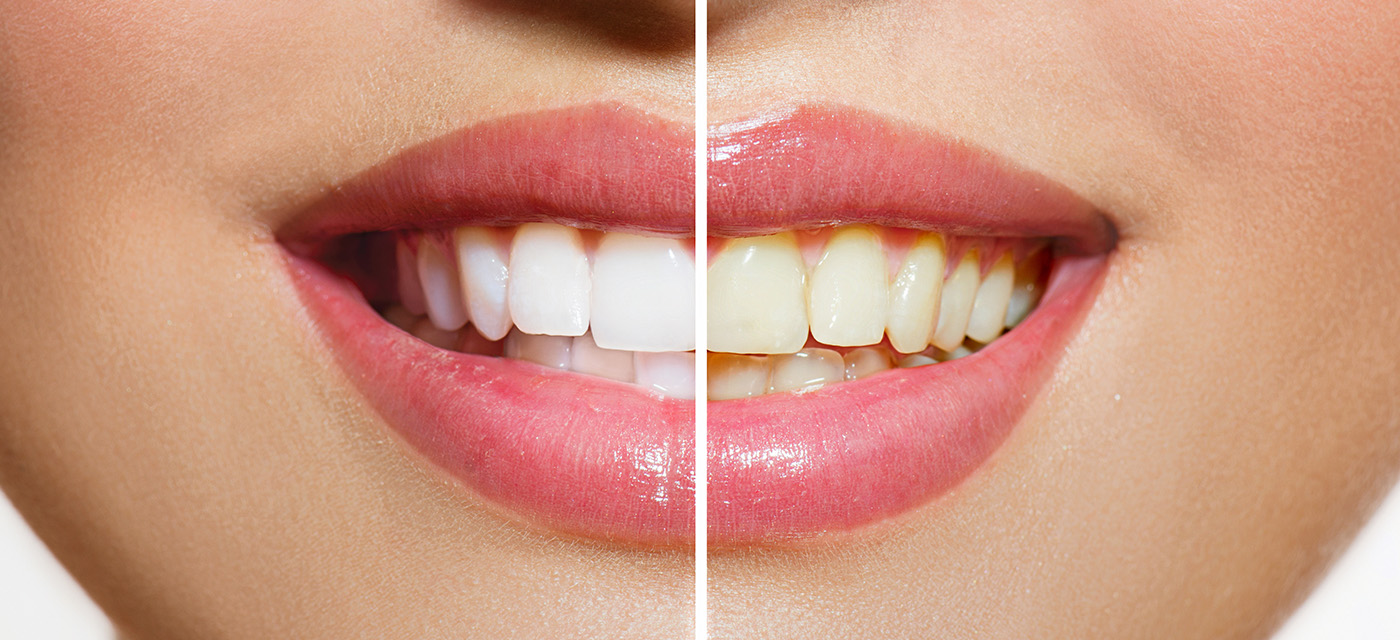 Antes y después de un blanqueamiento dental