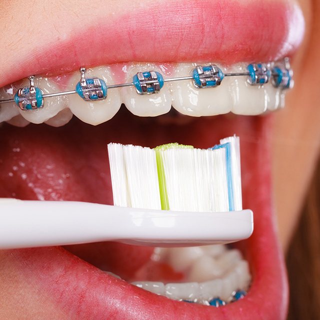 cepillado-de-dientes-con-ortodoncia