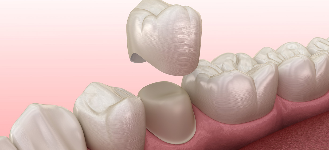 Procedimiento de colocar una corona dental en una pieza dental