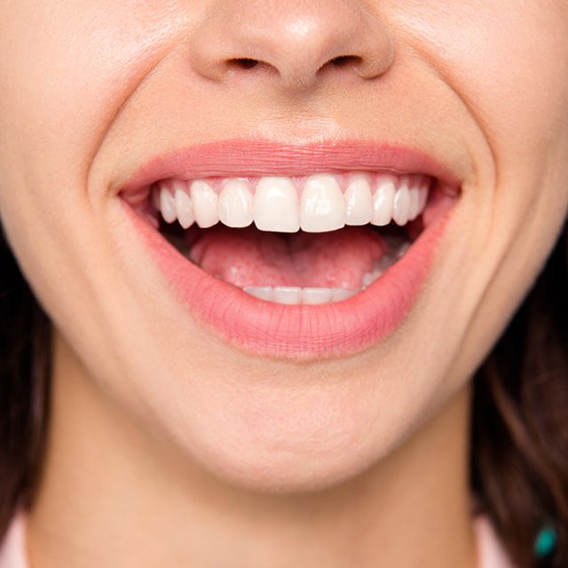 mujer con blanqueamiento dental