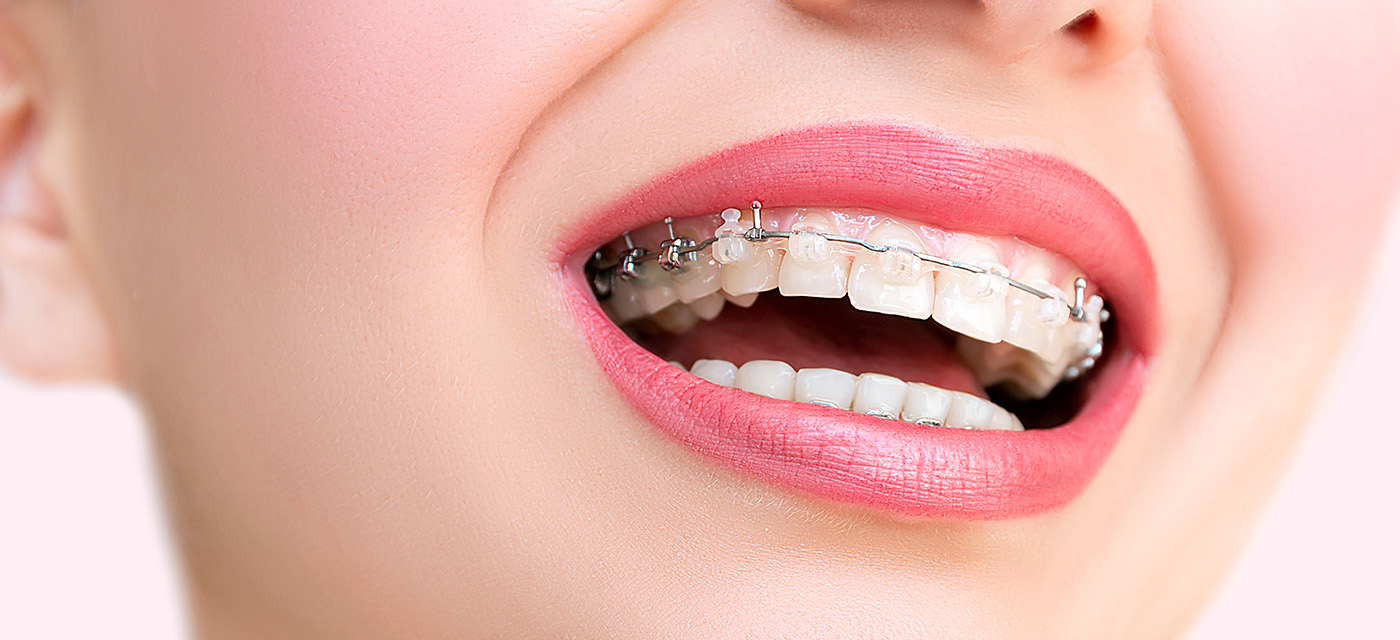 sonrisa de mujer con ortodoncia invisible