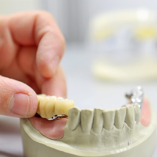 puentes dentales