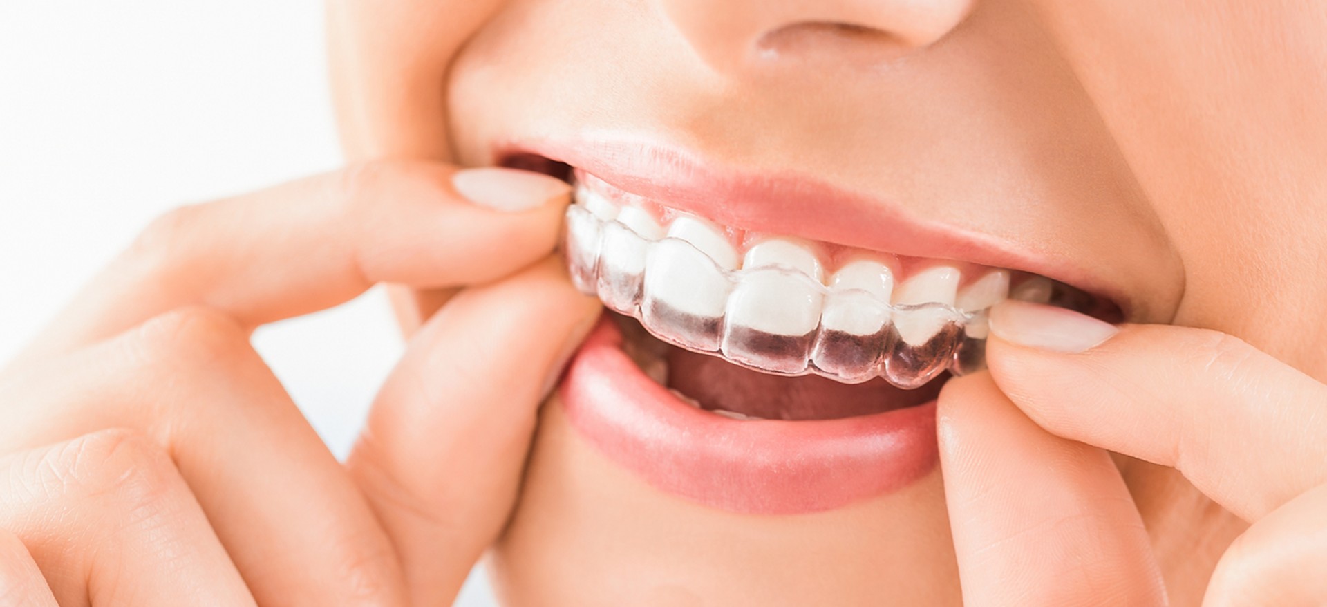 Persona sonriendo colocandose su Invisalign