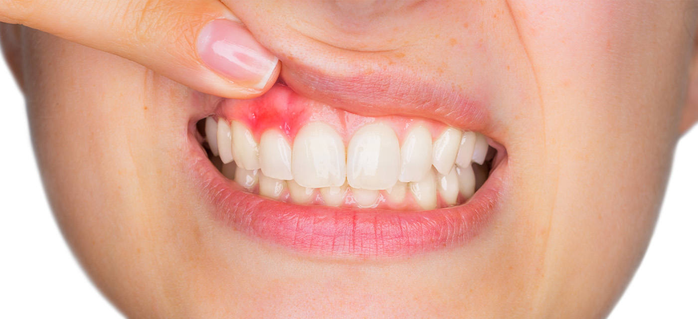 mujer con gingivitis