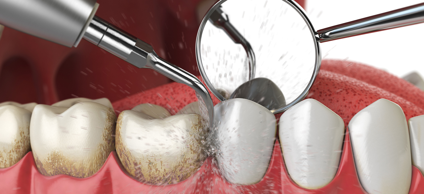 Procedimiento de profilaxis dental o Limpieza dental