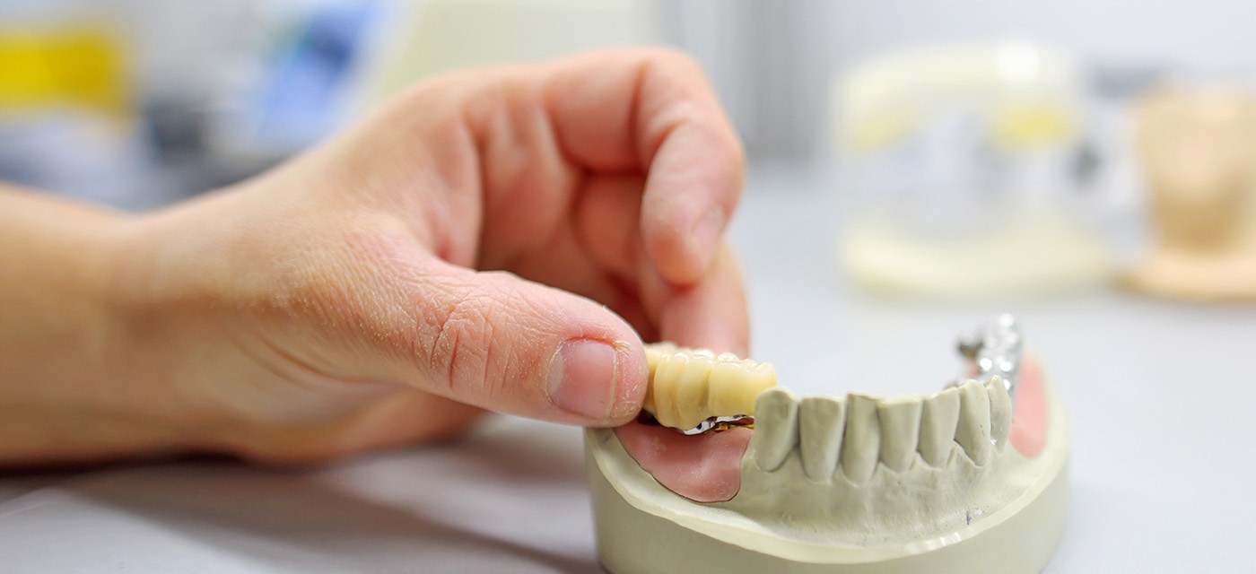 puentes dentales