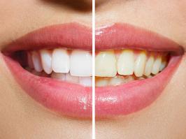 Antes y después de un blanqueamiento dental