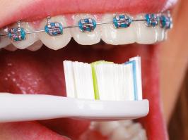 cepillado-de-dientes-con-ortodoncia