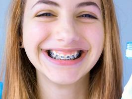 mujer con brackets de autoligado