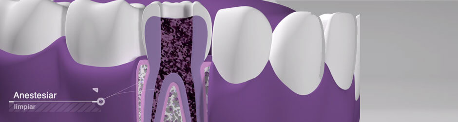 Vídeo endodoncia Vídeo endodoncia