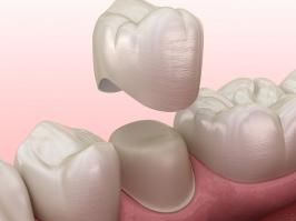 Procedimiento de colocar una corona dental en una pieza dental