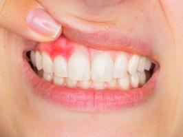 mujer con gingivitis