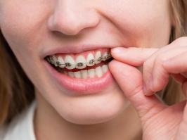 Mujer sonriendo con contorneado dental 