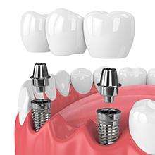 Implantes Dentales
