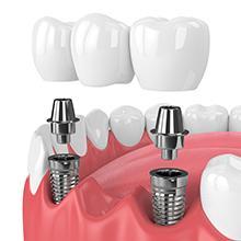 Tratamientos Implantes dentales